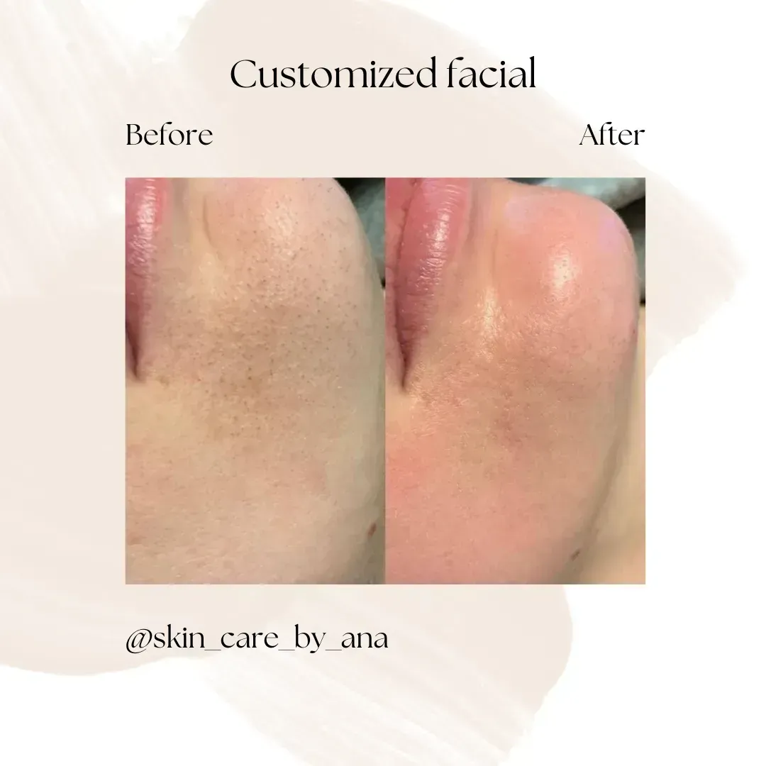 Before and after Customized facial — smoother, brighter skin at Skin Care by Ana, Tallinn