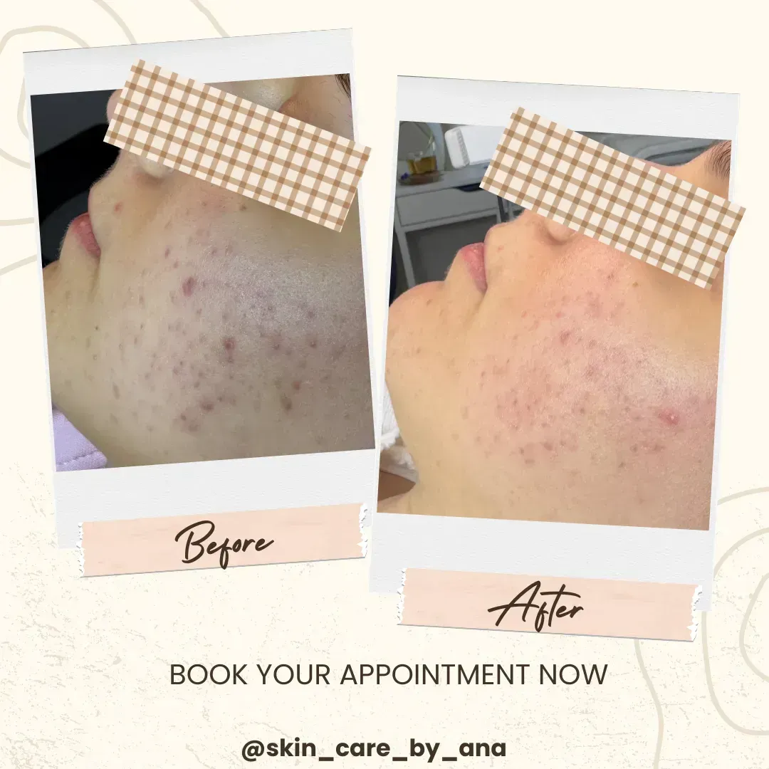Before and after Acne — calmer, clearer skin at Skin Care by Ana, Tallinn