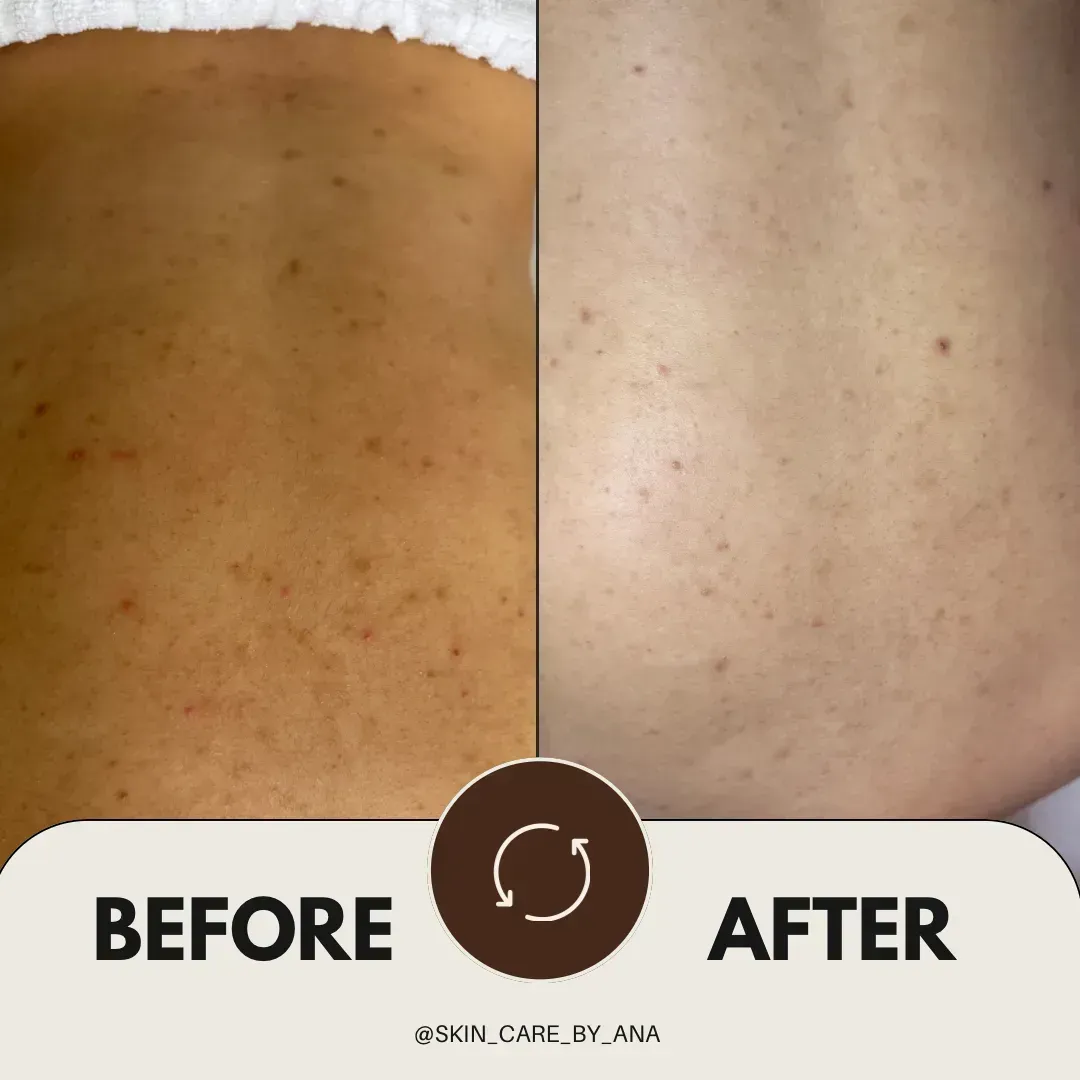 Before and after Smoother texture, calmer skin at Skin Care by Ana, Tallinn