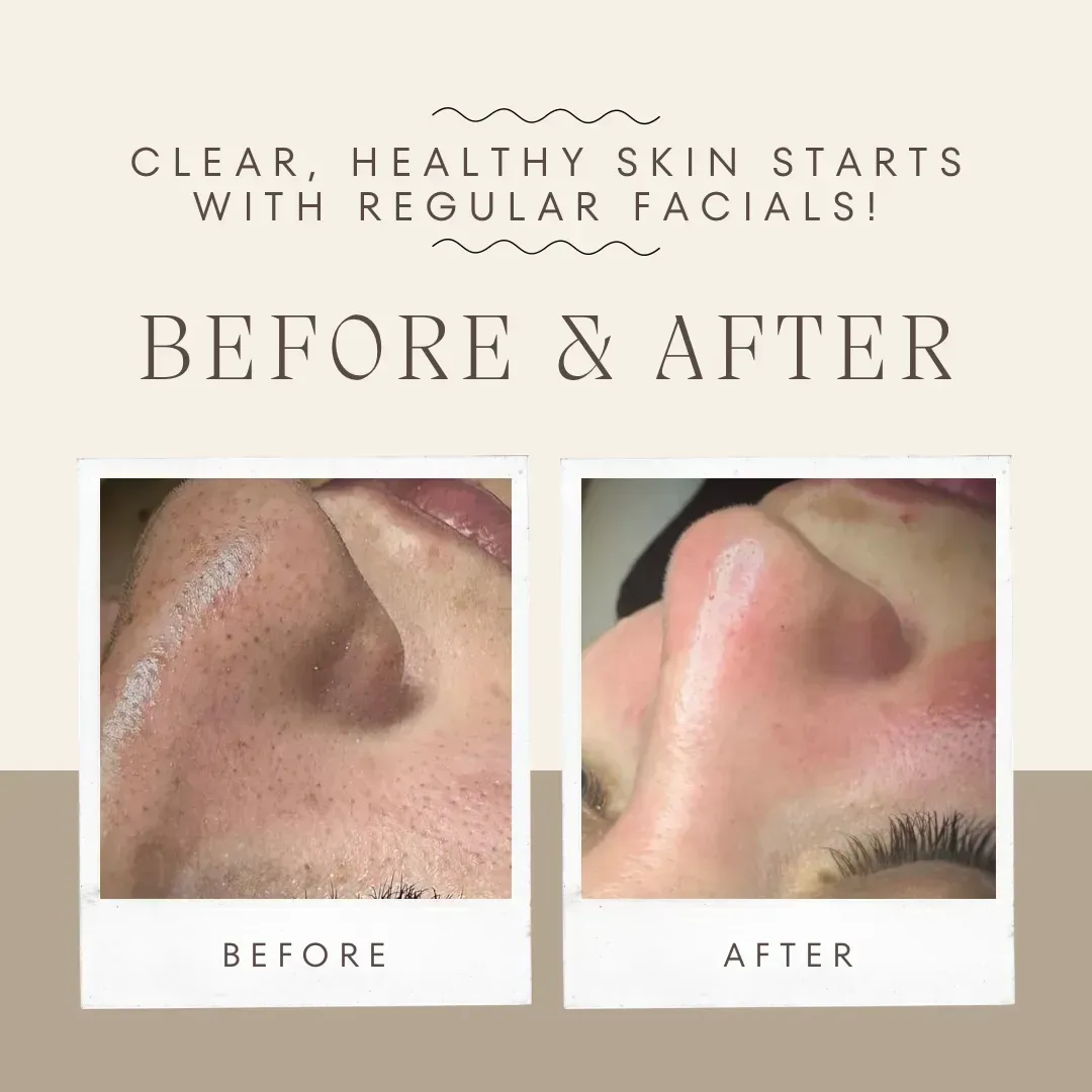 Before and after Refined pores at Skin Care by Ana, Tallinn