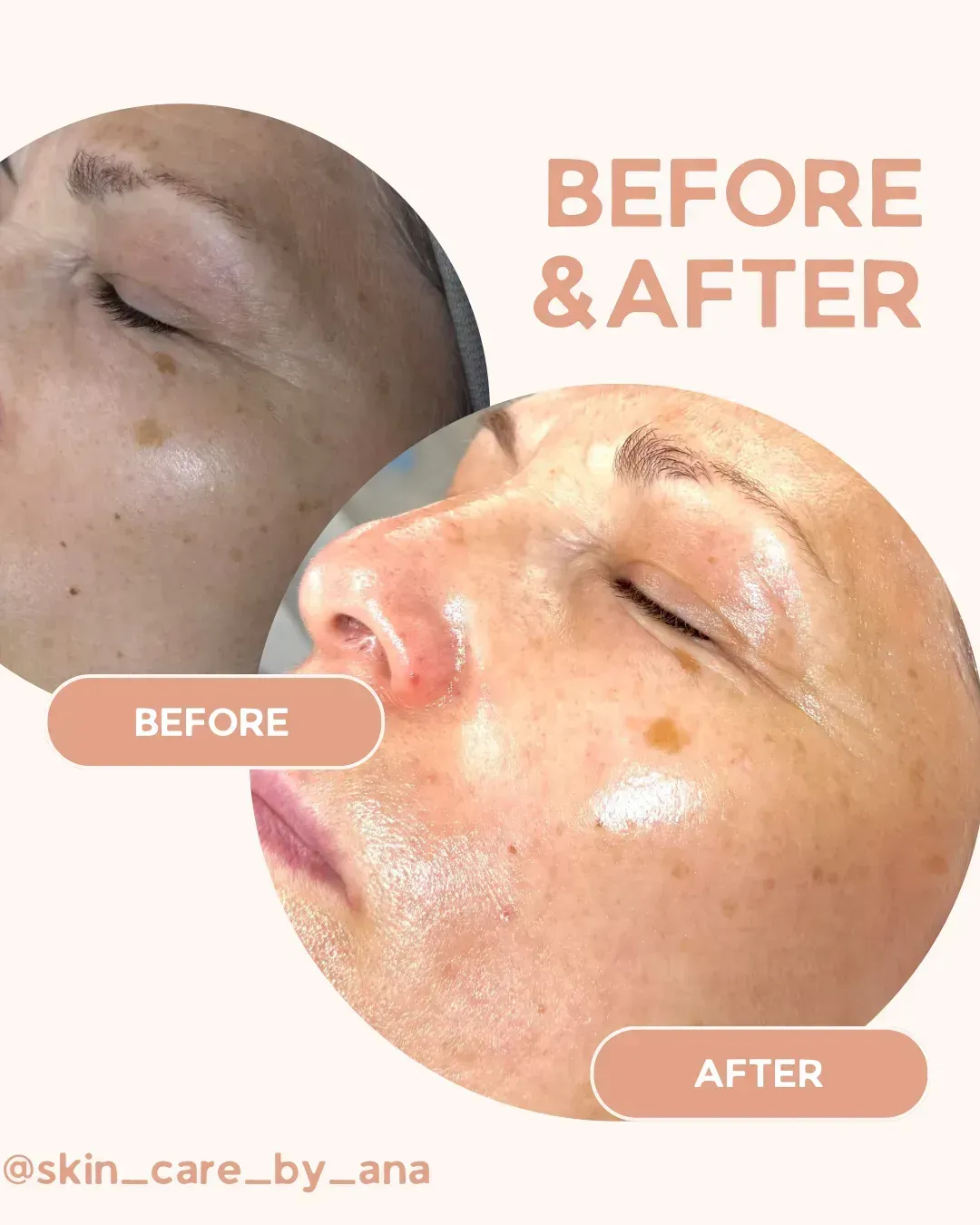 Before and after Renewed, even-toned glow at Skin Care by Ana, Tallinn